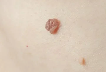 What are Skin Tags & Why do they form? – Tagband UK